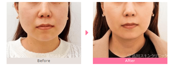 池袋でエラボトックスが安い人気クリニック10選 アラガンが打てて名医の病院は 後悔しないために打ち続けると老けるという噂を辛口解説 Kirei Memo